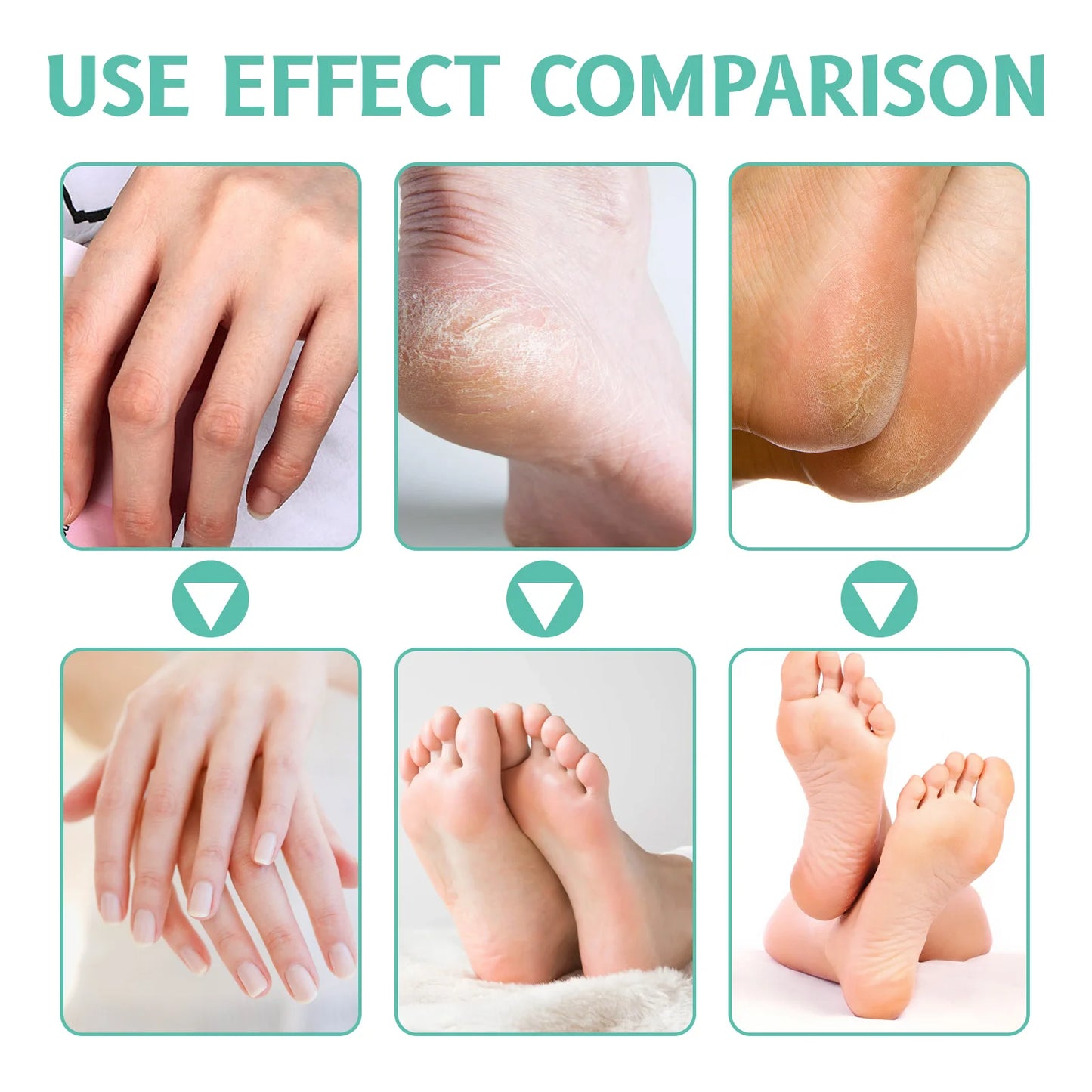 40% Urea + 2% Salicylic Acid Cream 100g for Dry Cracked Hands & Feet Deep Moisturizer Exfoliates Dead Skin Non-Greasy