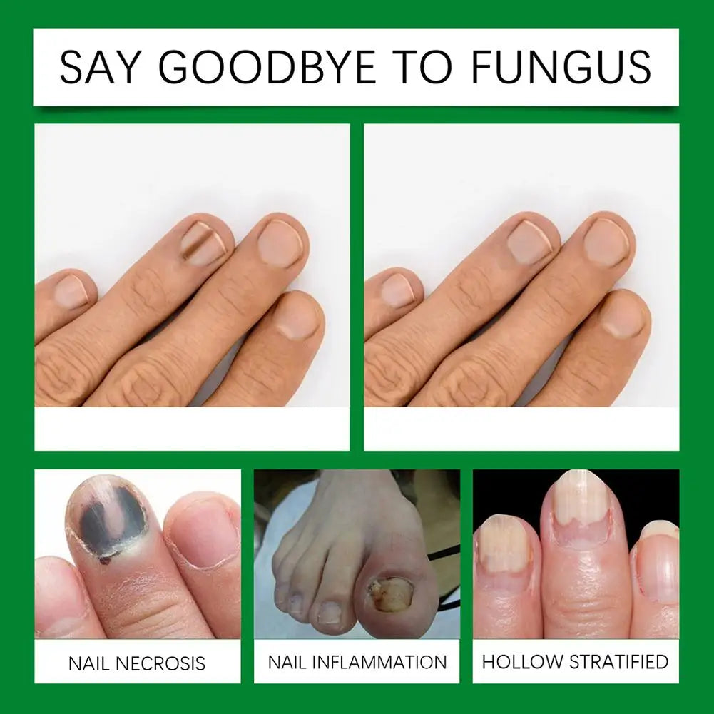 Tea Tree Nail Fungus Treatment Serum – Anti-Infection, Repair & Fungal Removal Cream