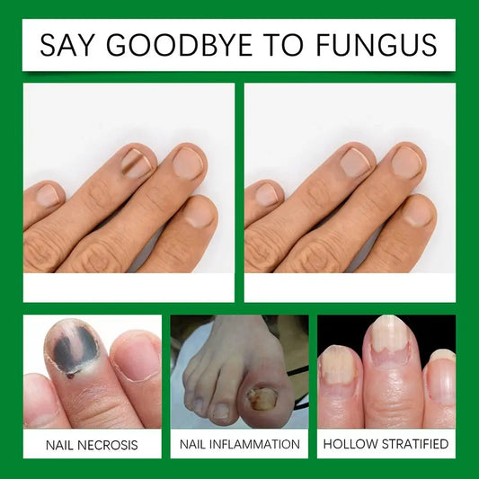 Tea Tree Nail Fungus Treatment Serum – Anti-Infection, Repair & Fungal Removal Cream