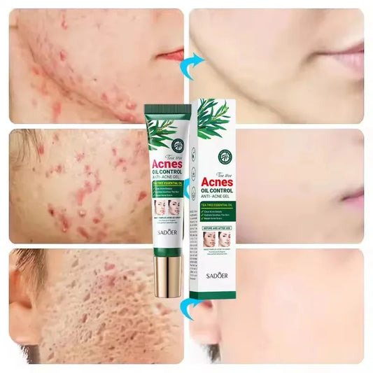 Tea Tree Acne Removing Cream – Mild Moisturizing, Oil Control & Pimples Treatment