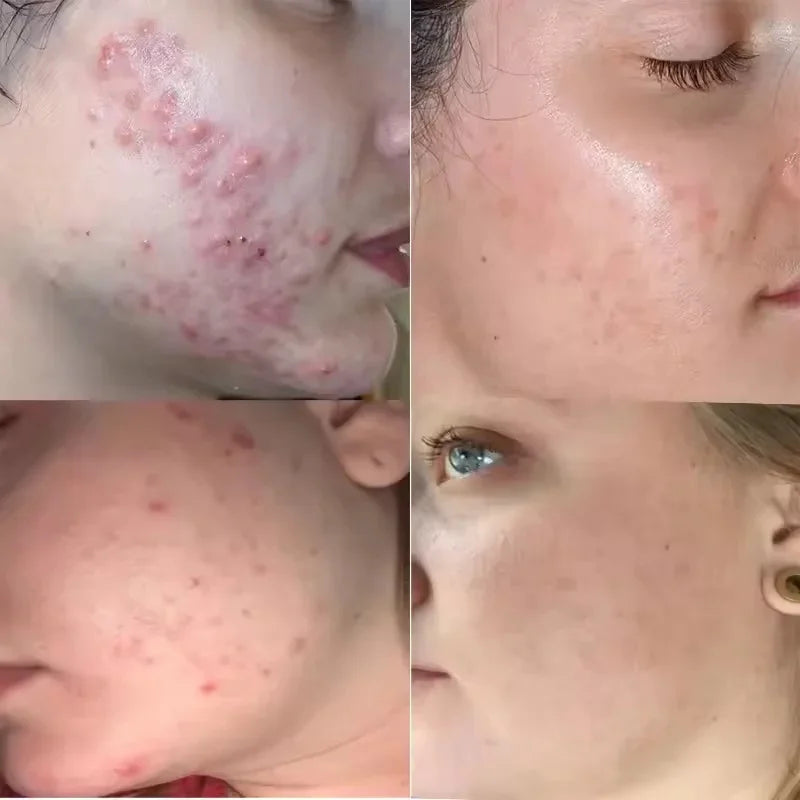 Tea Tree Acne Removing Cream – Mild Moisturizing, Oil Control & Pimples Treatment