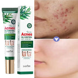 Tea Tree Acne Removing Cream – Mild Moisturizing, Oil Control & Pimples Treatment