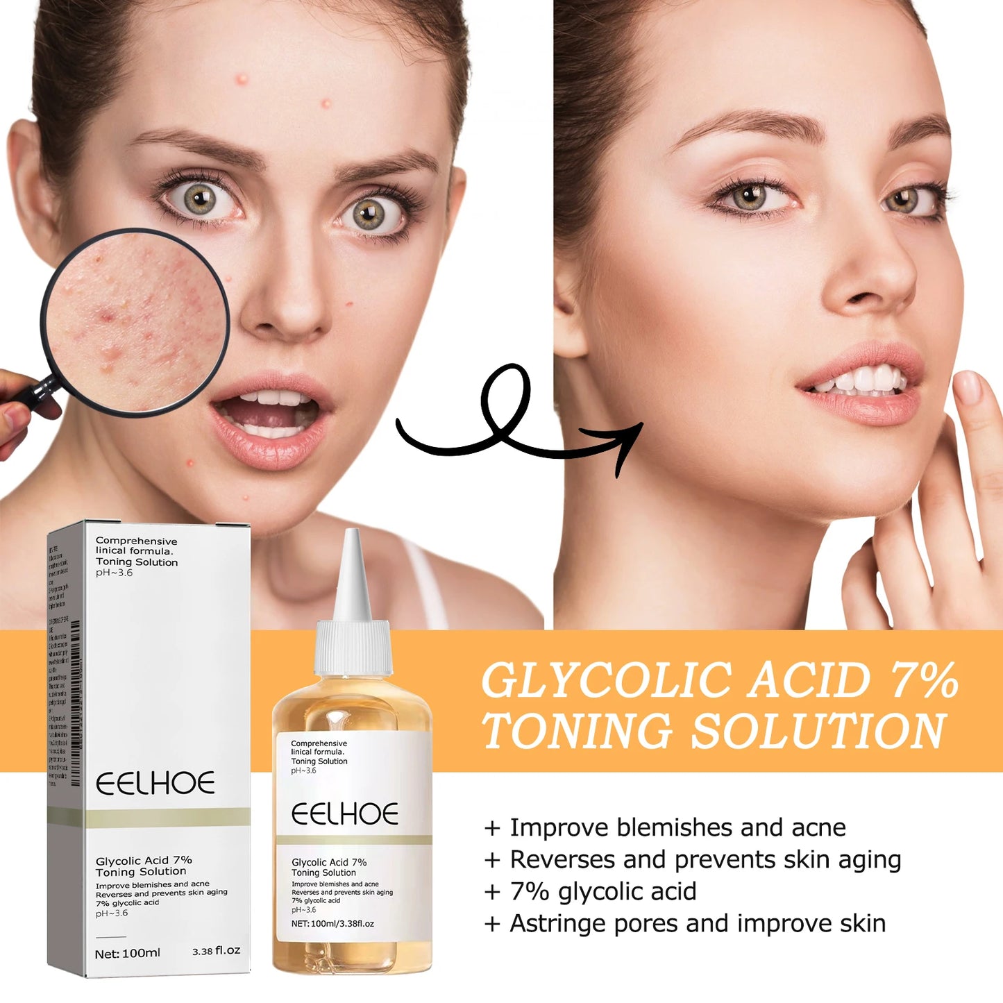 7% Glycolic Acid Toner – Acne, Blackhead Treatment, Hydrating & Skin Smoothing